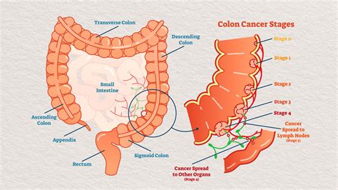 labs that indicate colon cancer